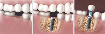 implant-dentar-etape1